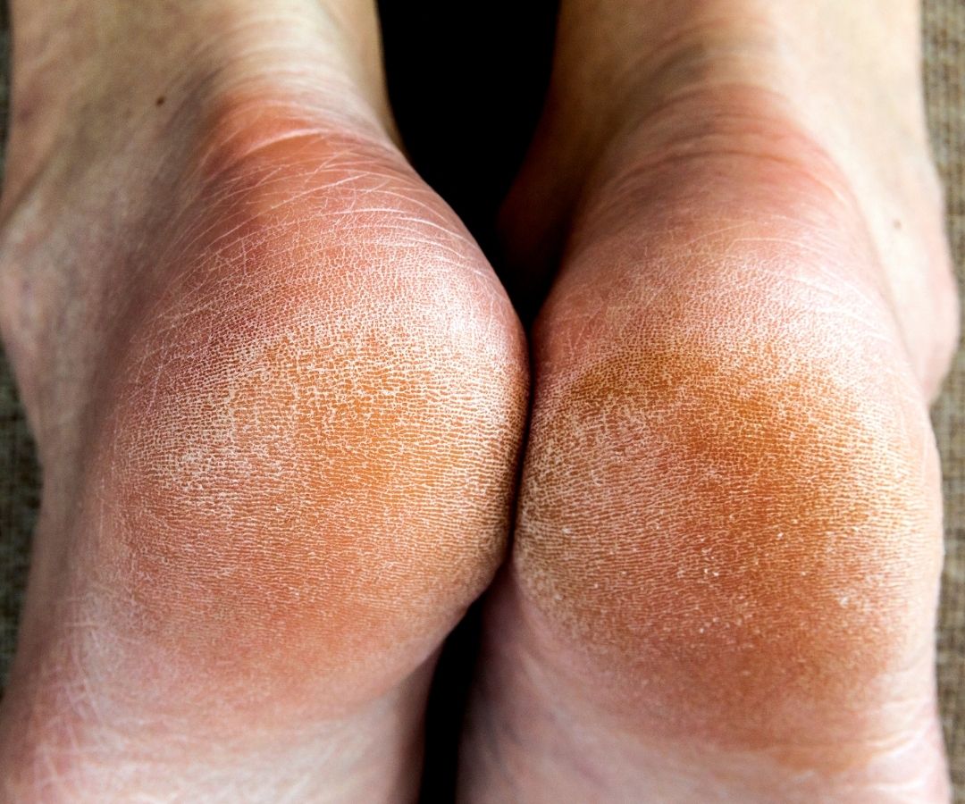 Eeltige voeten (Callused Feet)