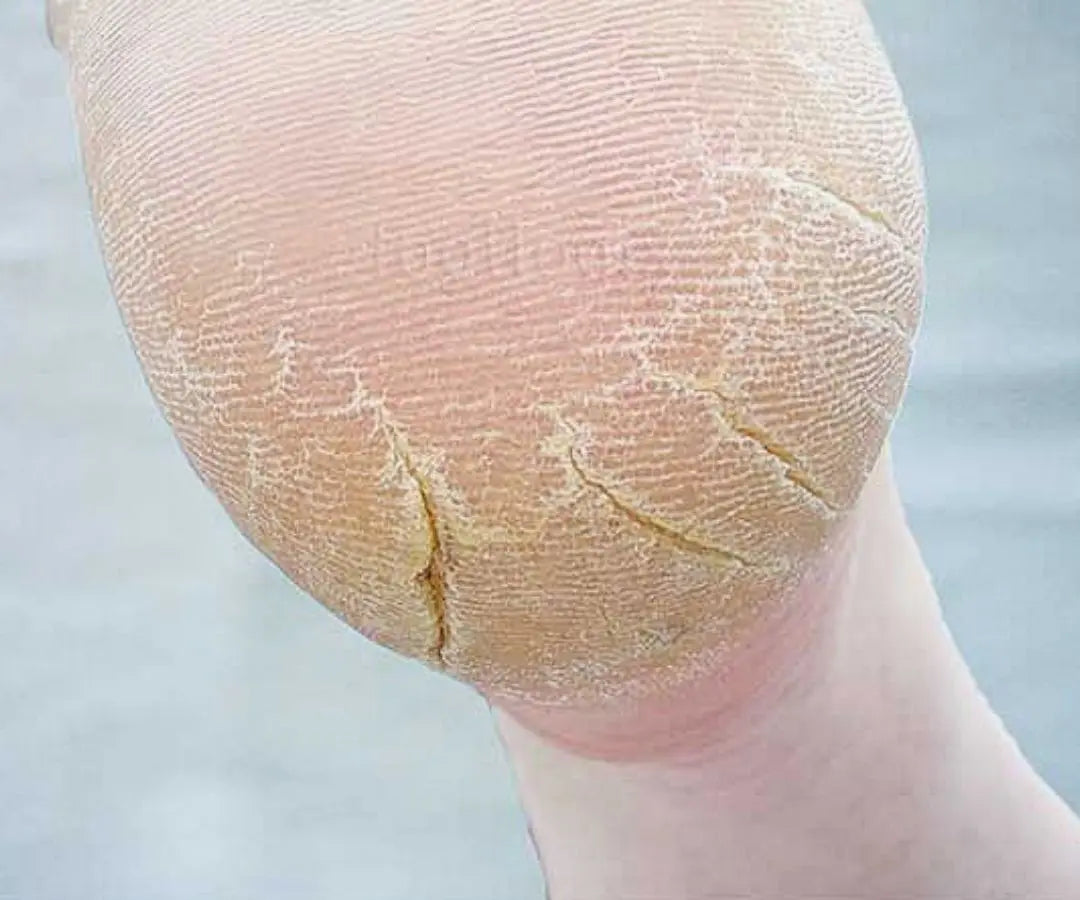 Kloofjes in de hielen (Cracked Heels)