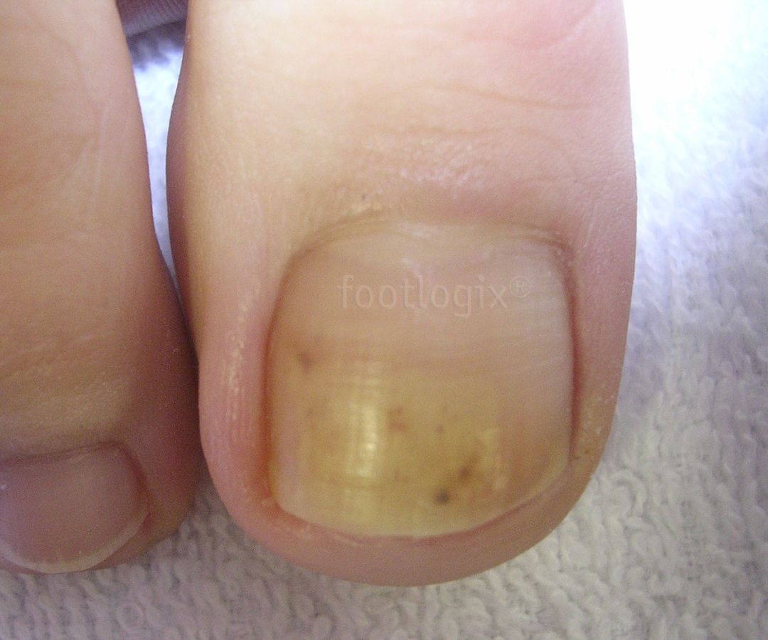 Nagelverkleuring (Nail Discoloration)