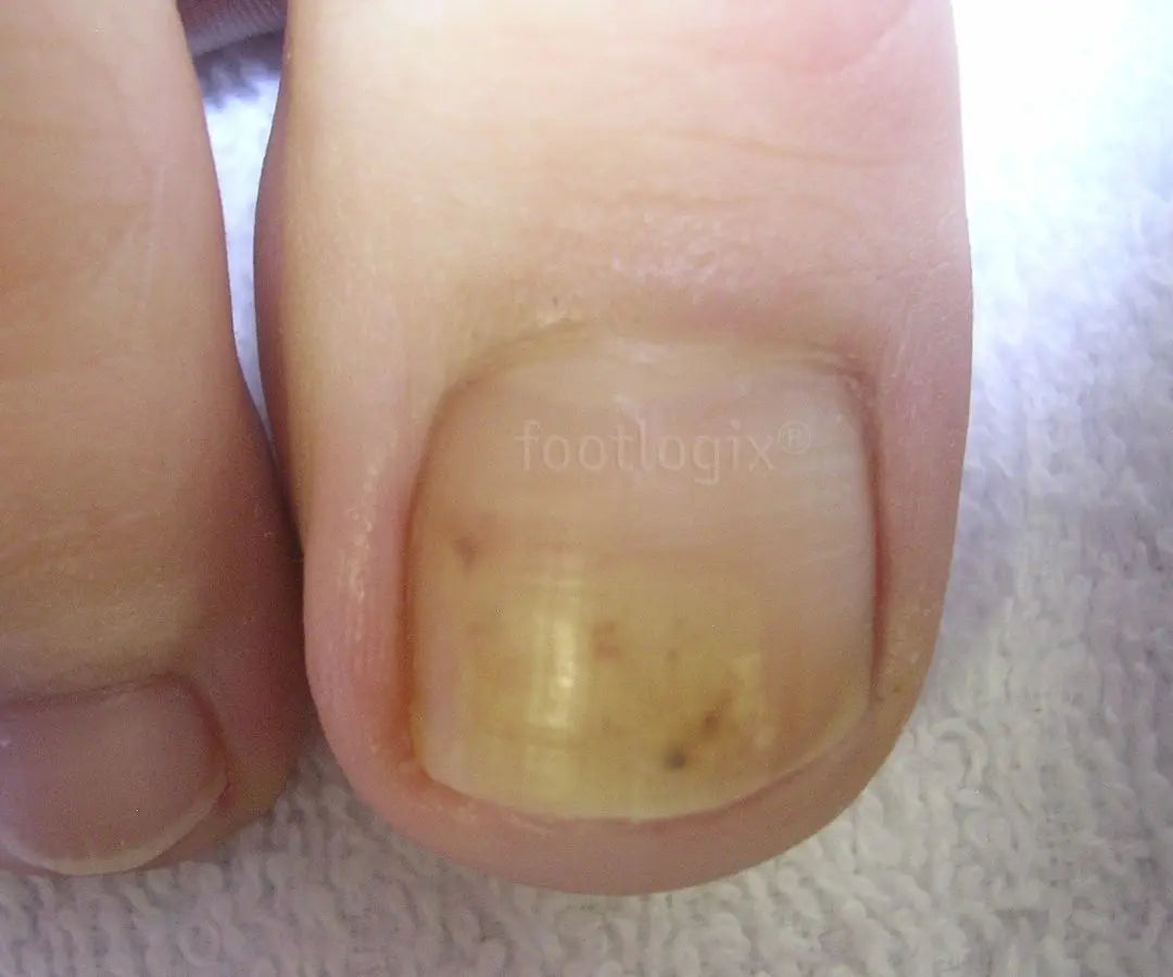 Nagelverkleuring (Nail Discoloration)