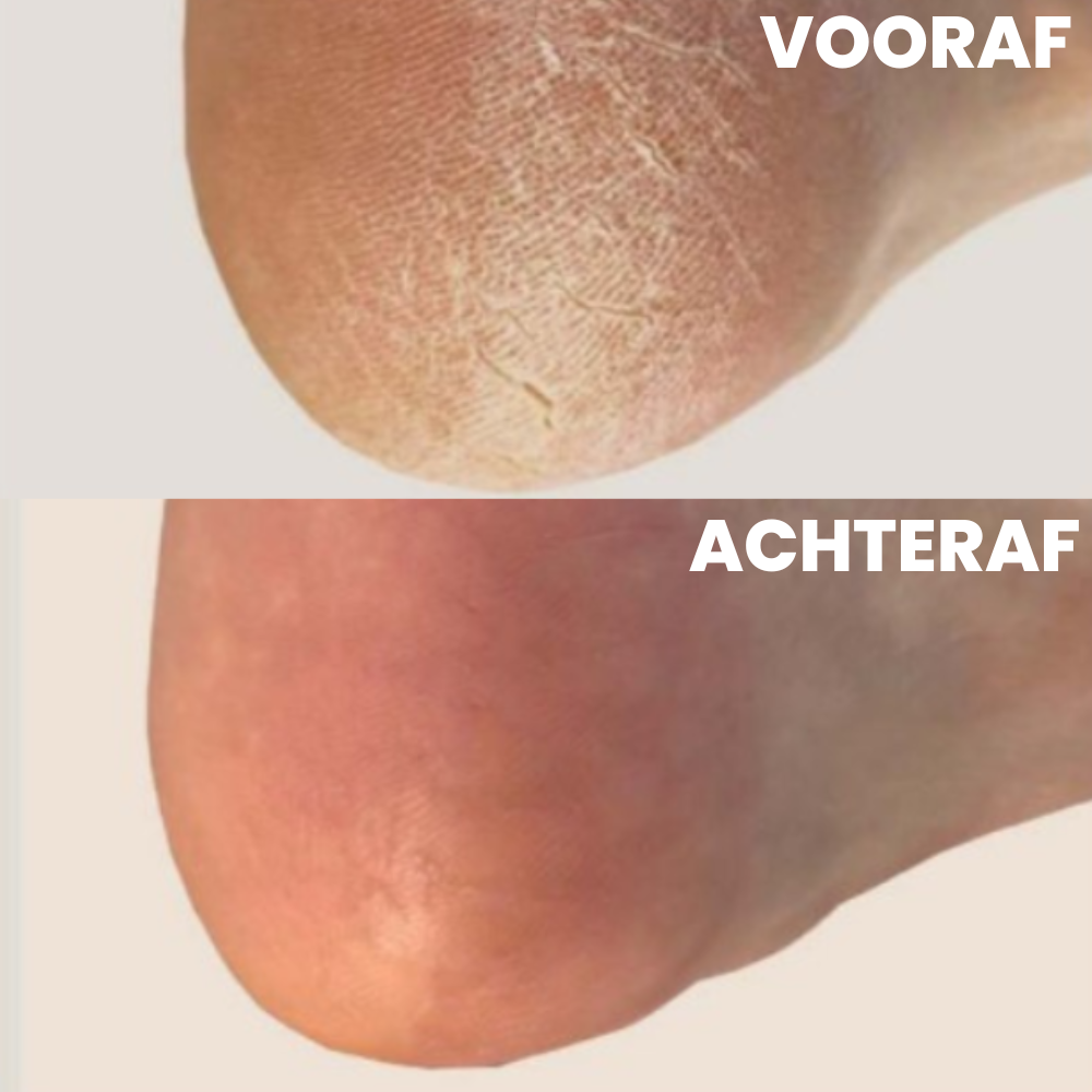 Before and after comparison of dry, cracked heel skin showing improved smooth texture.