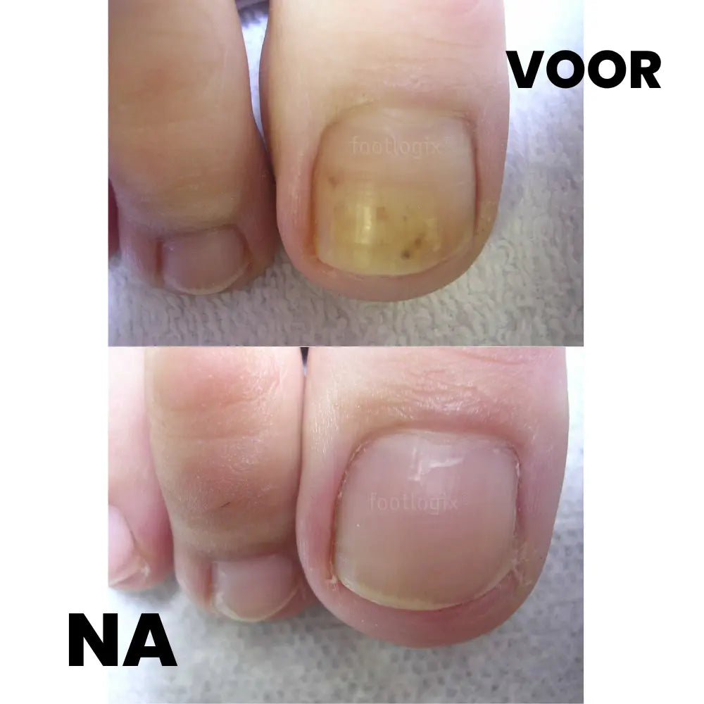 Footlogix Anti-Fungal Toe Nail Tincture 7T - 50 ml Footlogix before and after use 