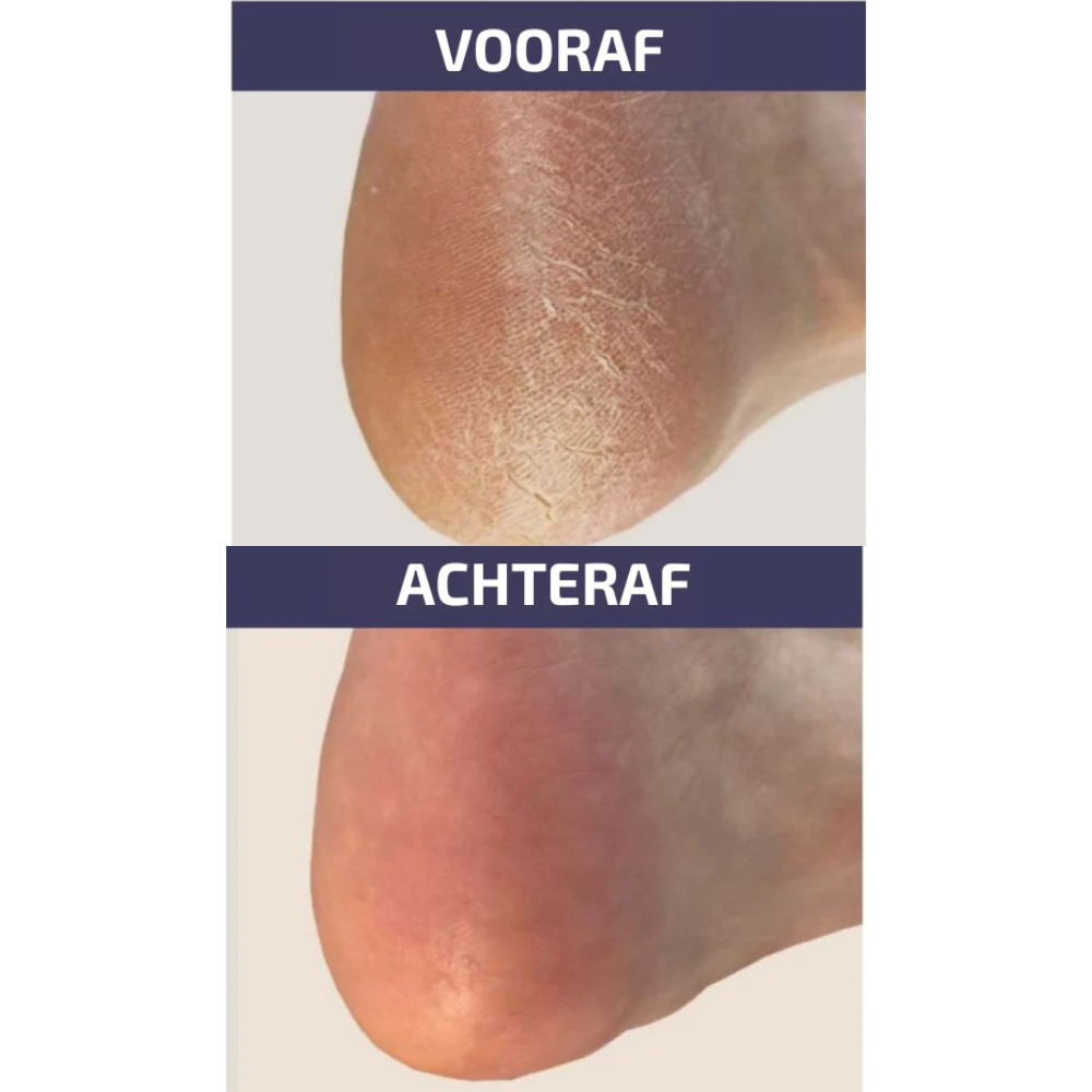 Voor & na: Footlogix At Home Voetvijl – zichtbaar verschil bij droge, ruwe en eeltige voeten vóór en na gebruik