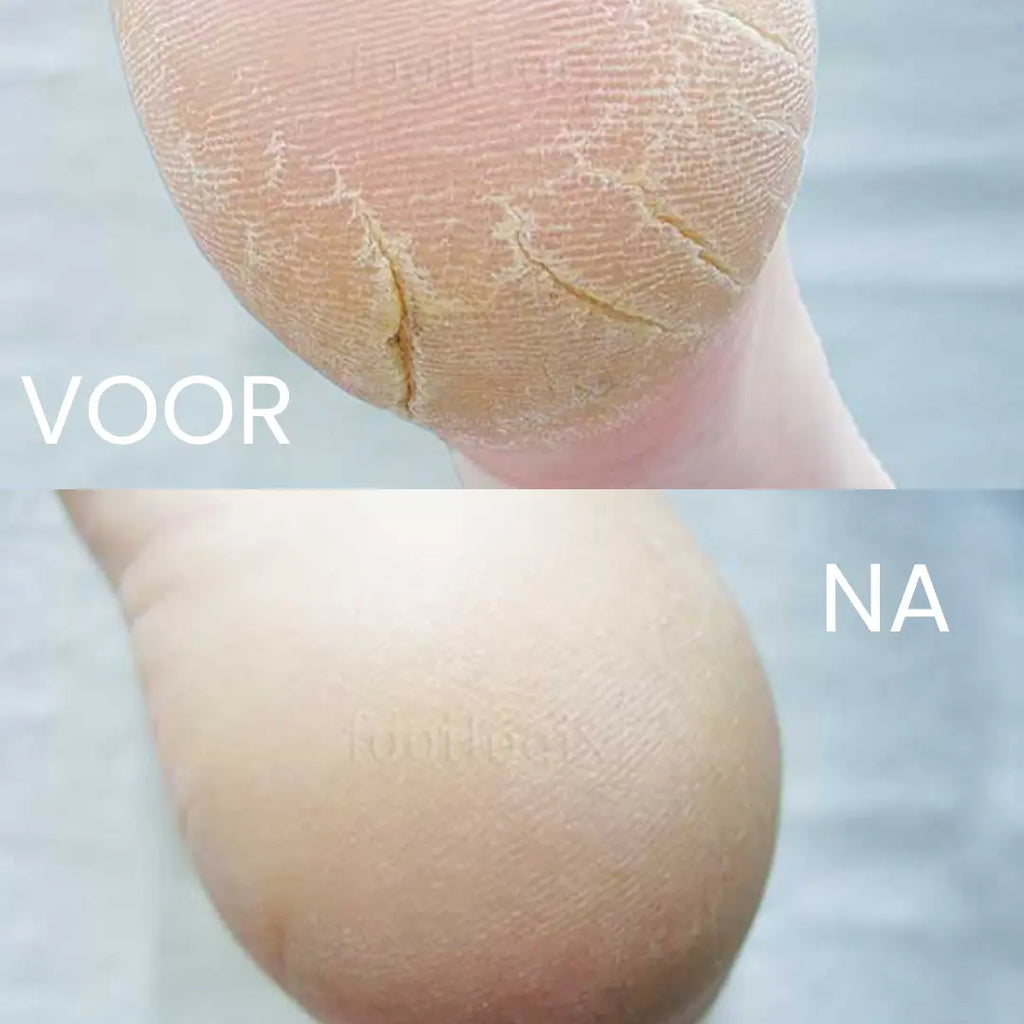 Footlogix Cracked Heel Formula 3+ - 125 ml Footlogix results before and after use 