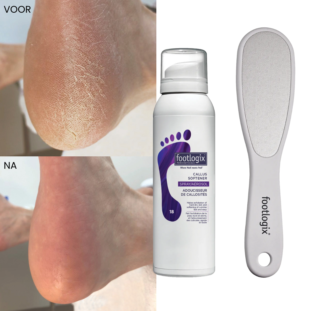 Footlogix Ultimate At-Home Foot Care Combo 100 ml Footlogix Before and After results 